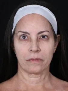 MILA patient recovery journey, Patient 3 — Pre-op