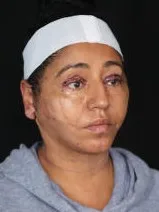 MILA patient recovery journey, Patient 7 — Day 1