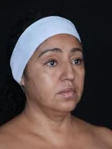 MILA patient recovery journey, Patient 7 — Pre-op