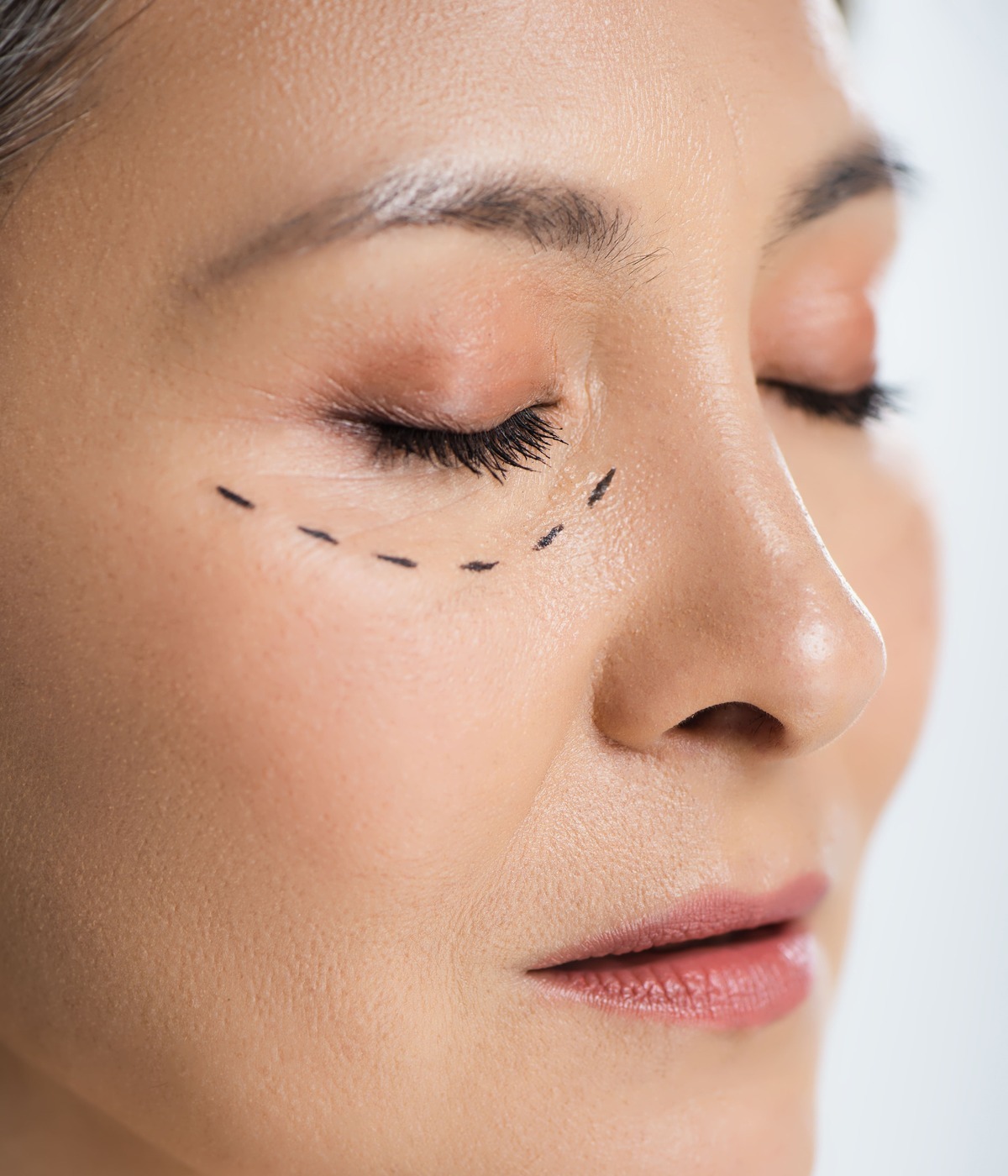 Eyelid lift blepharoplasty — MILA Face